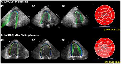 Left Ventricular Global Longitudinal Strain Is Associated With Cardiovascular Outcomes in Patients Who Underwent Permanent Pacemaker Implantation